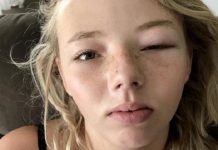 Kmart眼膜或致14歲女半失明